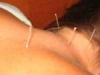 neck-and-back-acupuncture-150x150